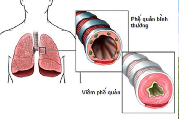 Viêm phế quản là gì