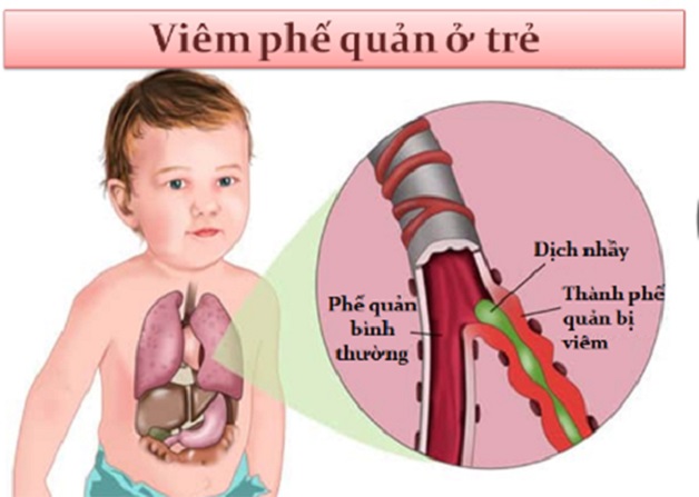 viêm phế quản ở trẻ