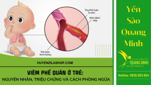 Viêm phế quản ở trẻ: Nguyên nhân, triệu chứng và cách phòng ngừa